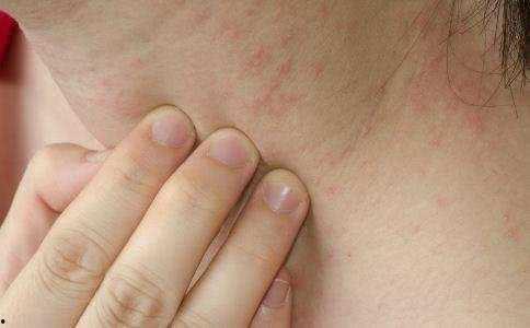 患了湿疹可以吃哈密瓜吗,哈密瓜的益处与注意事项